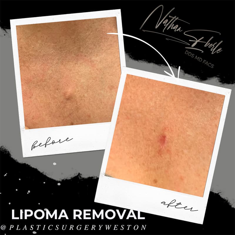 Lipoma Removal before and after case 1, actual patient at Weston Center for Plastic Surgery
