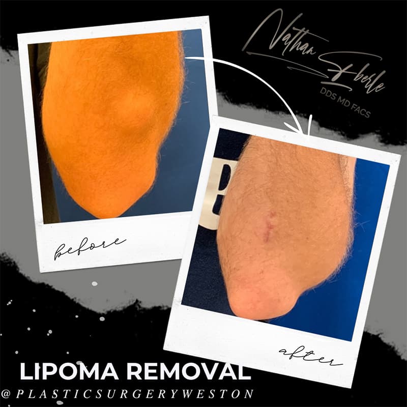 Lipoma Removal before and after case 2, actual patient at Weston Center for Plastic Surgery