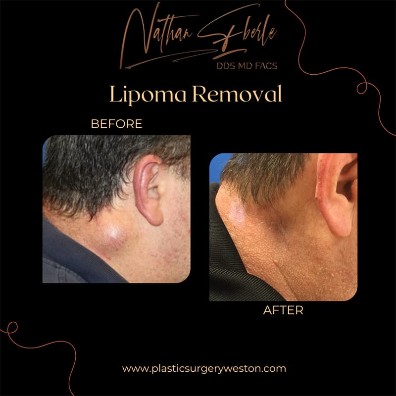 Lipoma Removal before and after case 3, actual patient at Weston Center for Plastic Surgery
