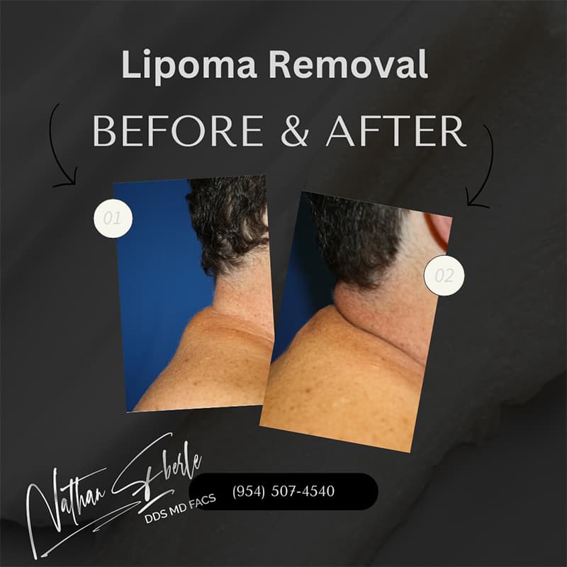 Lipoma Removal before and after case 4, actual patient at Weston Center for Plastic Surgery