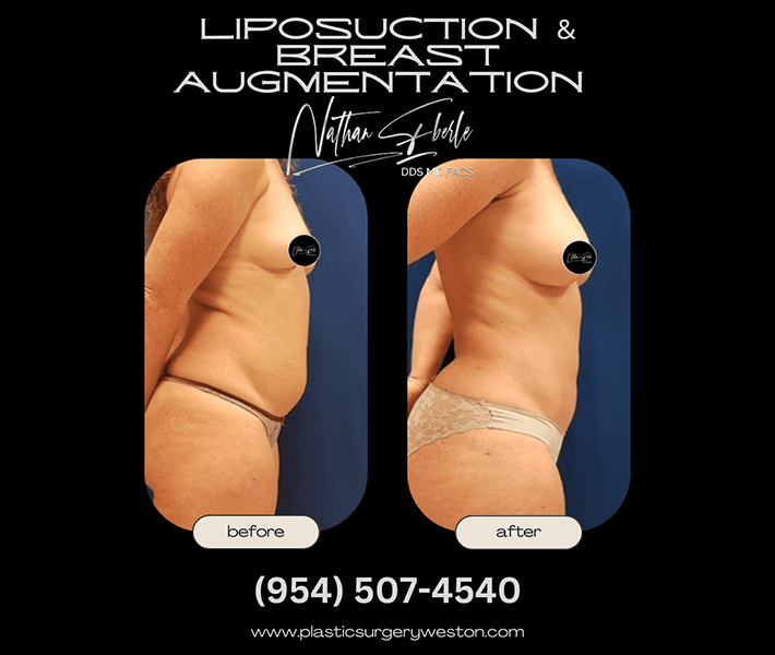 Liposuction before and after case 1, actual patient at Weston Center for Plastic Surgery