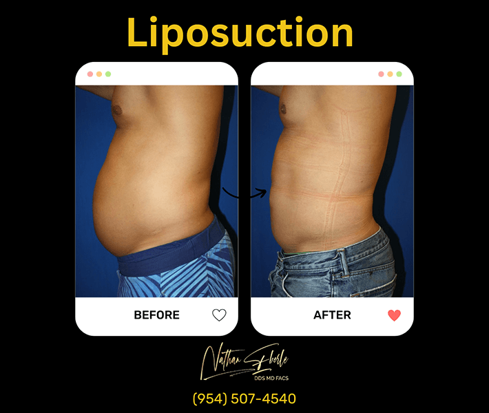 Liposuction before and after case 10, actual patient at Weston Center for Plastic Surgery
