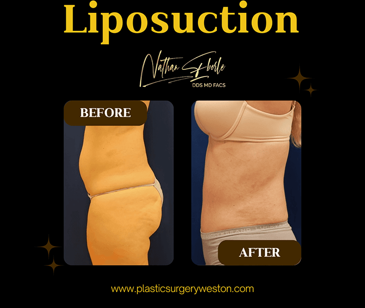 Liposuction before and after case 11, actual patient at Weston Center for Plastic Surgery