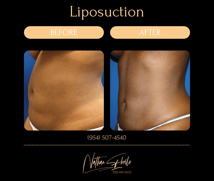 Liposuction before and after case 12, actual patient at Weston Center for Plastic Surgery