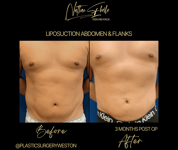 Liposuction before and after case 19, actual patient at Weston Center for Plastic Surgery