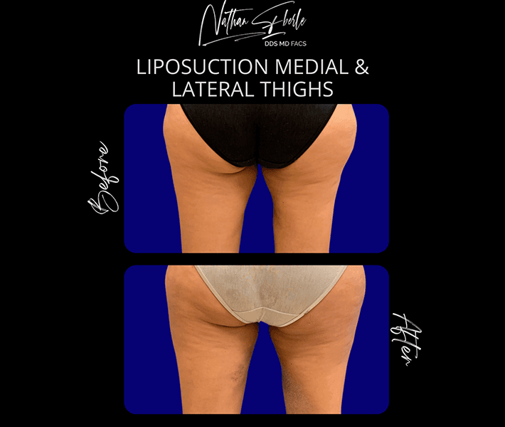 Liposuction before and after case 2, actual patient at Weston Center for Plastic Surgery