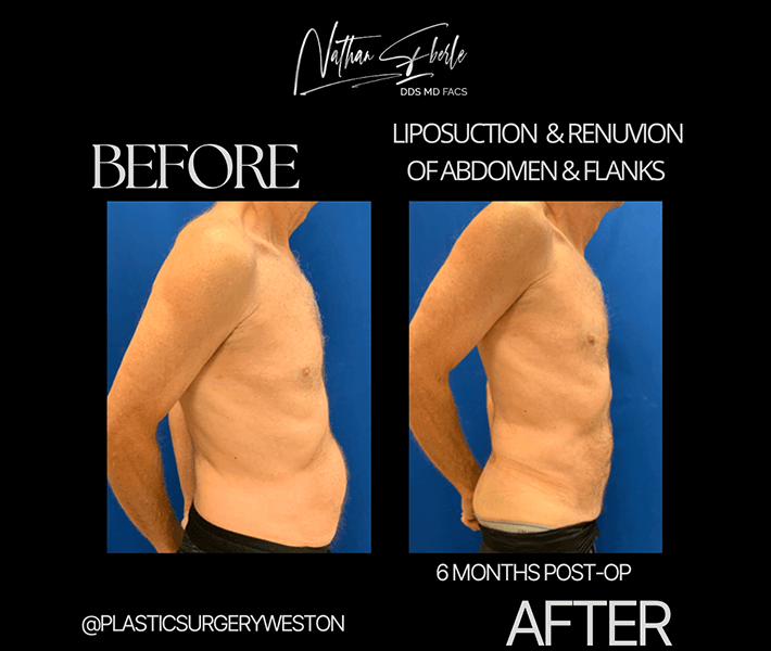 Liposuction before and after case 21, actual patient at Weston Center for Plastic Surgery