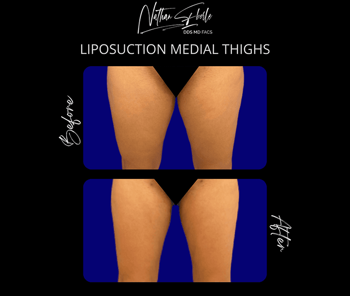 Liposuction before and after case 22, actual patient at Weston Center for Plastic Surgery