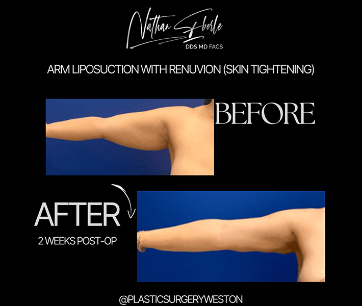 Liposuction before and after case 23, actual patient at Weston Center for Plastic Surgery