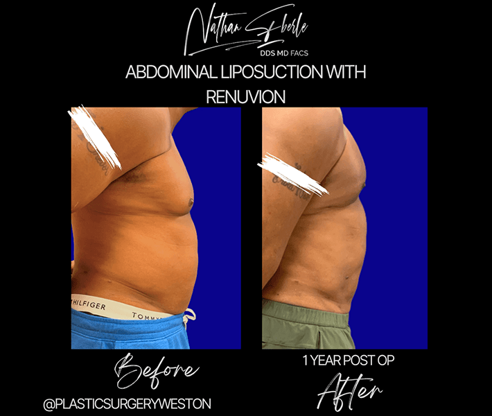 Liposuction before and after case 24, actual patient at Weston Center for Plastic Surgery