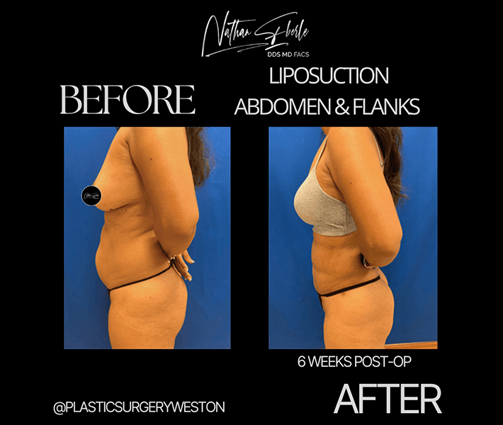 Liposuction before and after case 25, actual patient at Weston Center for Plastic Surgery