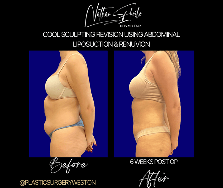 Liposuction before and after case 26, actual patient at Weston Center for Plastic Surgery