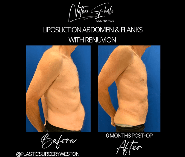 Liposuction before and after case 27, actual patient at Weston Center for Plastic Surgery
