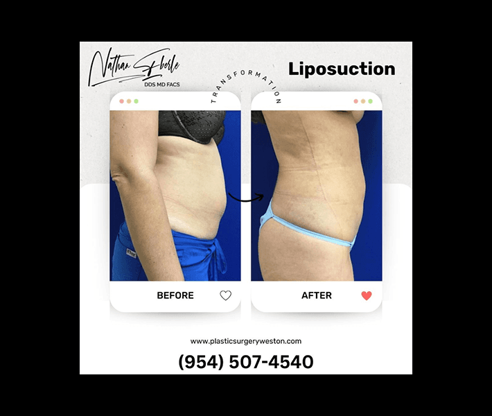 Liposuction before and after case 3, actual patient at Weston Center for Plastic Surgery