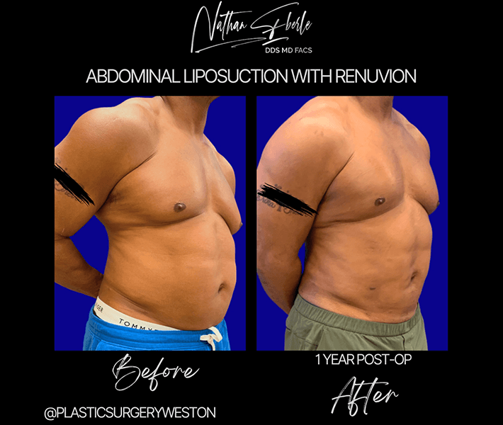 Liposuction before and after case 32, actual patient at Weston Center for Plastic Surgery