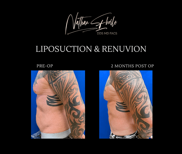 Liposuction before and after case 33, actual patient at Weston Center for Plastic Surgery