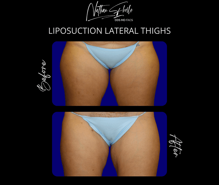Liposuction before and after case 35, actual patient at Weston Center for Plastic Surgery