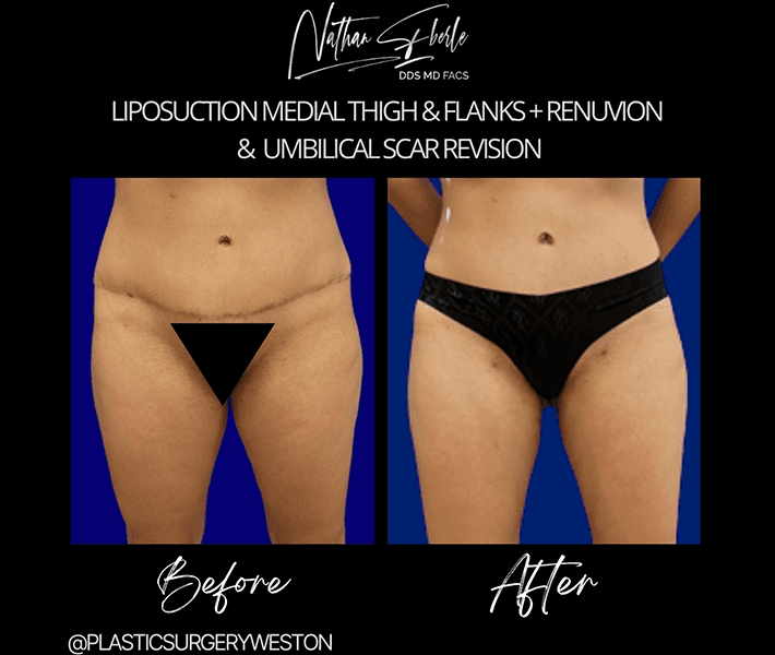 Liposuction before and after case 36, actual patient at Weston Center for Plastic Surgery