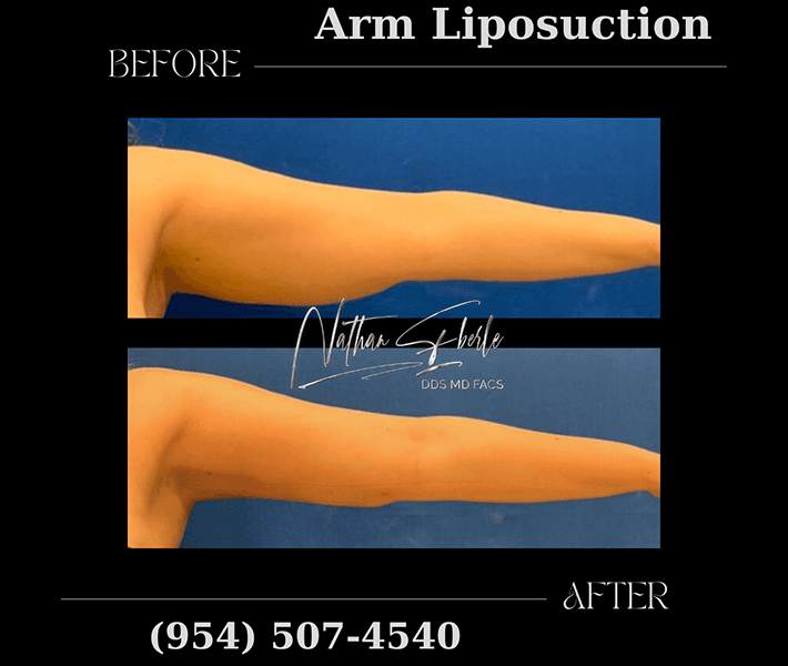 Liposuction before and after case 37, actual patient at Weston Center for Plastic Surgery