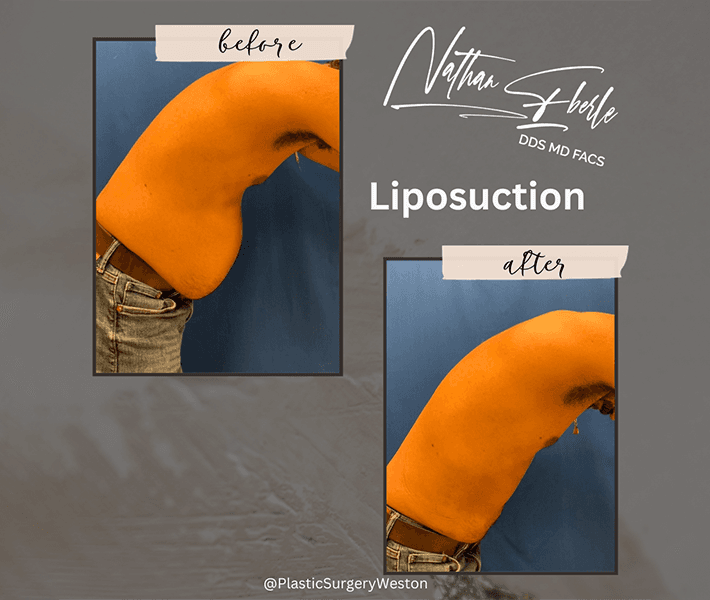 Liposuction before and after case 38, actual patient at Weston Center for Plastic Surgery