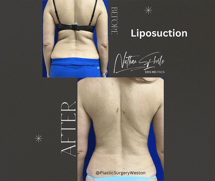 Liposuction before and after case 39, actual patient at Weston Center for Plastic Surgery