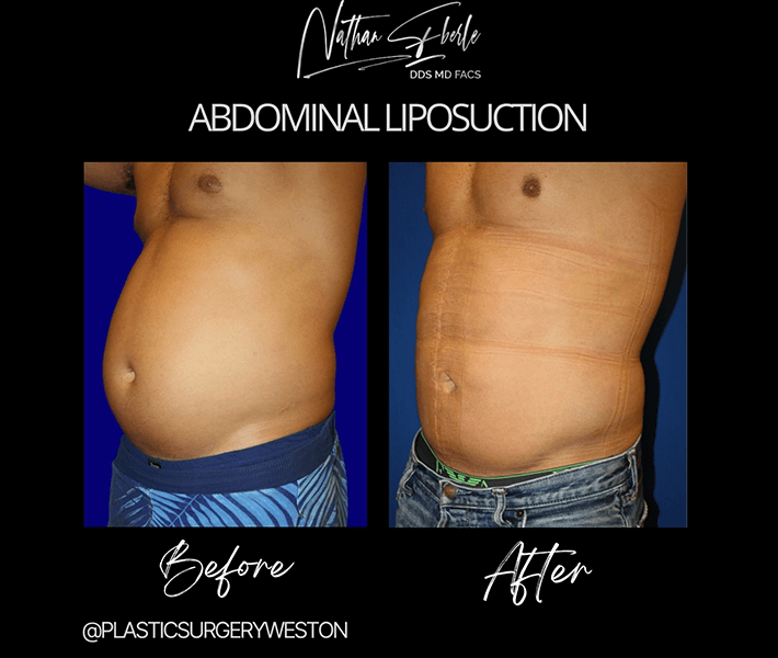 Liposuction before and after case 4, actual patient at Weston Center for Plastic Surgery