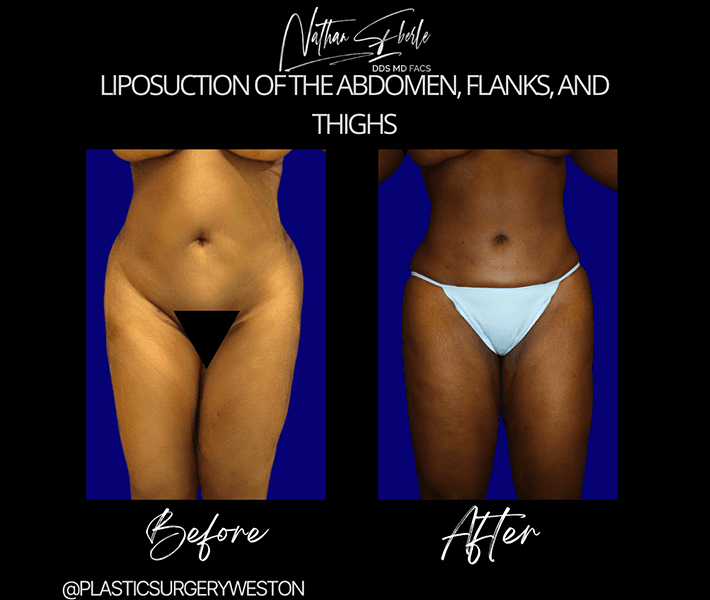Liposuction before and after case 40, actual patient at Weston Center for Plastic Surgery