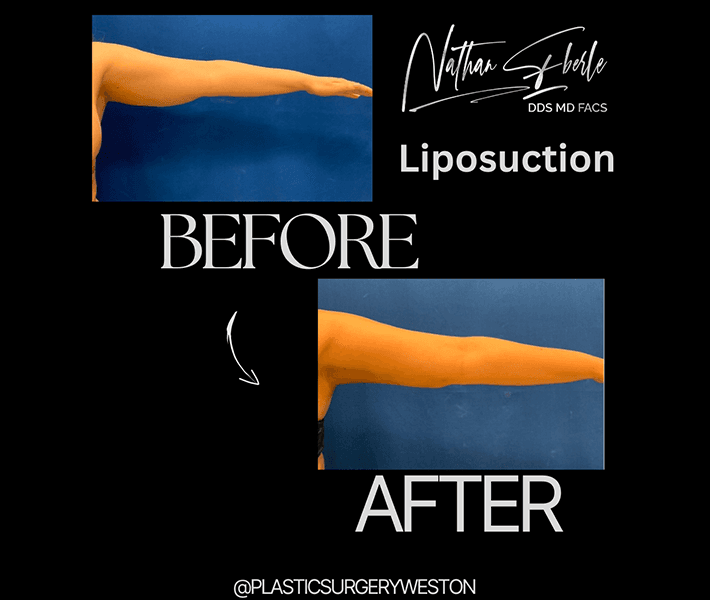 Liposuction before and after case 41, actual patient at Weston Center for Plastic Surgery