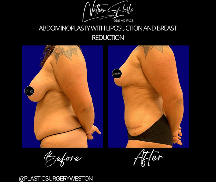 Liposuction before and after case 43, actual patient at Weston Center for Plastic Surgery