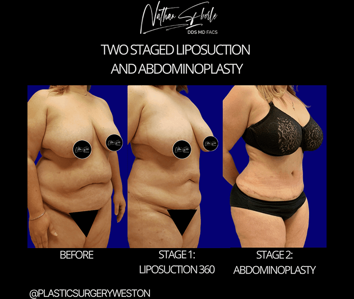 Liposuction before and after case 44, actual patient at Weston Center for Plastic Surgery