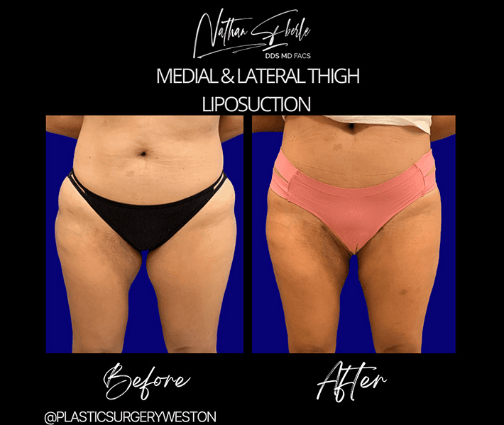 Liposuction before and after case 45, actual patient at Weston Center for Plastic Surgery