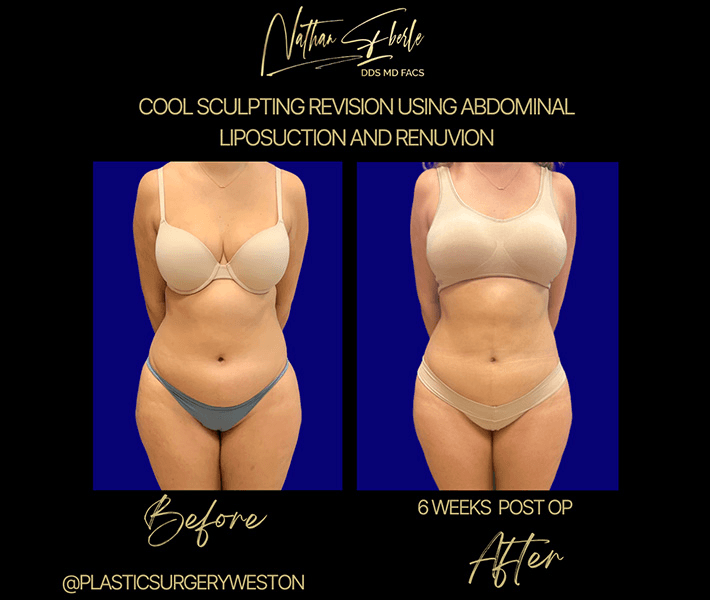 Liposuction before and after case 46, actual patient at Weston Center for Plastic Surgery
