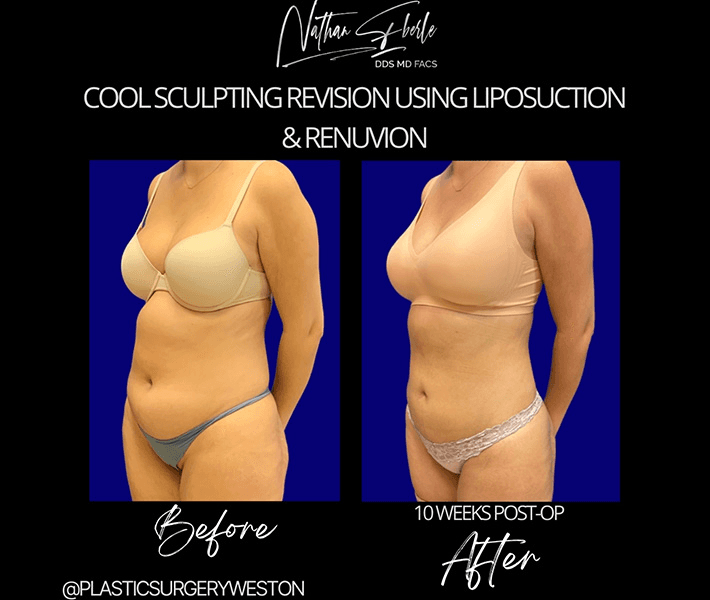 Liposuction before and after case 47, actual patient at Weston Center for Plastic Surgery
