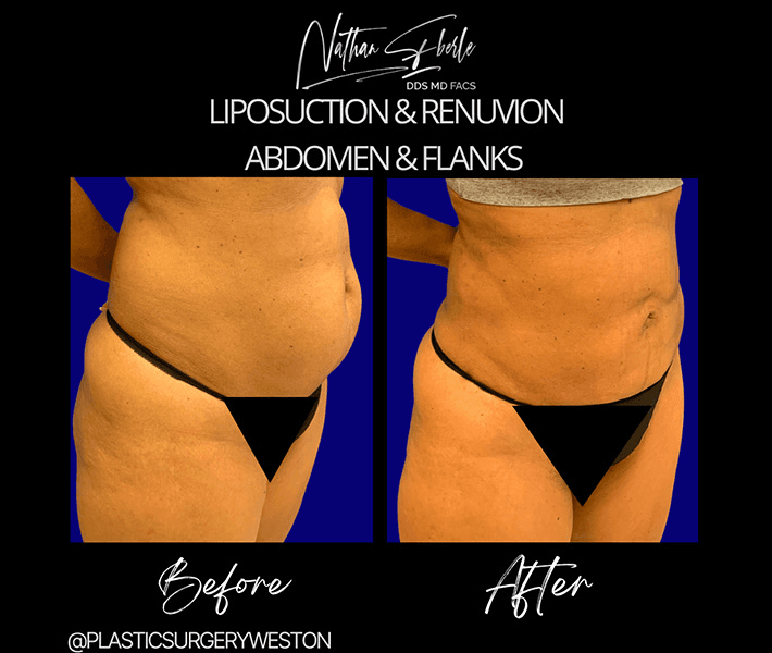 Liposuction before and after case 48, actual patient at Weston Center for Plastic Surgery