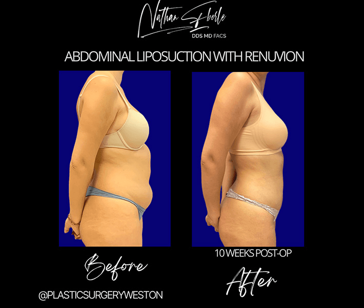 Liposuction before and after case 49, actual patient at Weston Center for Plastic Surgery