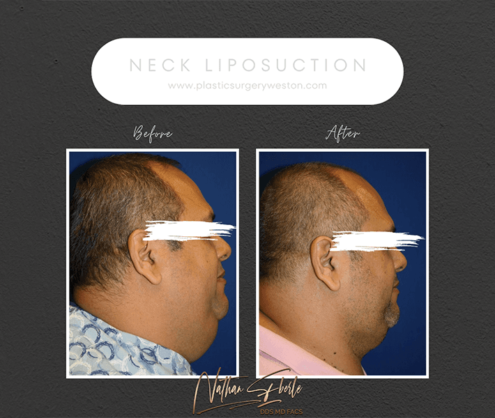 Liposuction before and after case 5, actual patient at Weston Center for Plastic Surgery