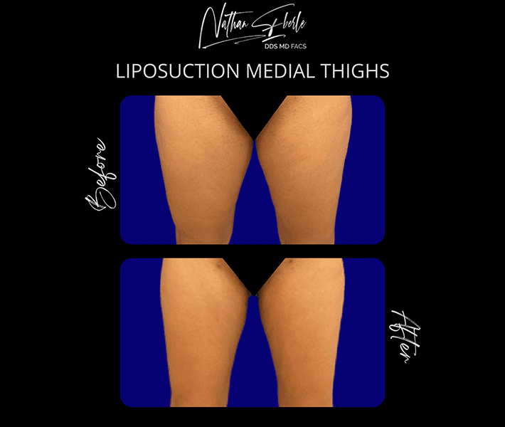 Liposuction before and after case 51, actual patient at Weston Center for Plastic Surgery