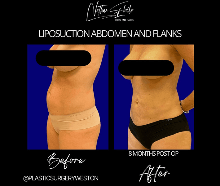 Liposuction before and after case 53, actual patient at Weston Center for Plastic Surgery
