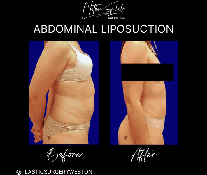 Liposuction before and after case 54, actual patient at Weston Center for Plastic Surgery