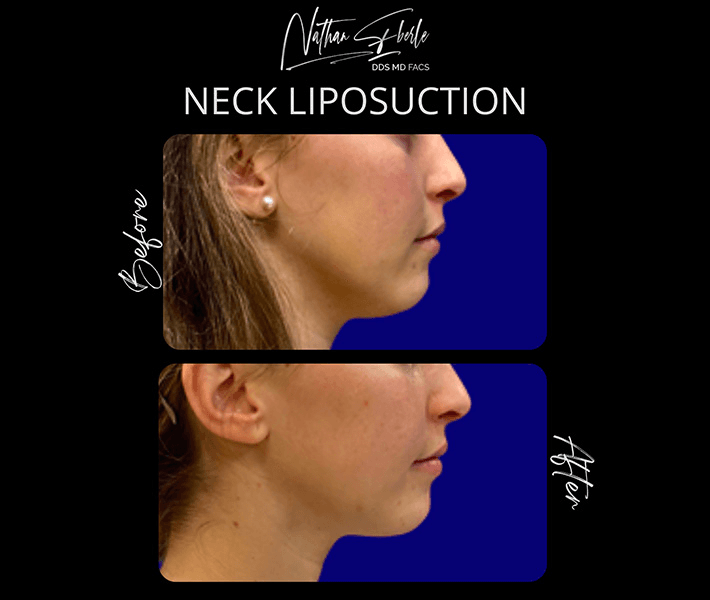 Liposuction before and after case 55, actual patient at Weston Center for Plastic Surgery