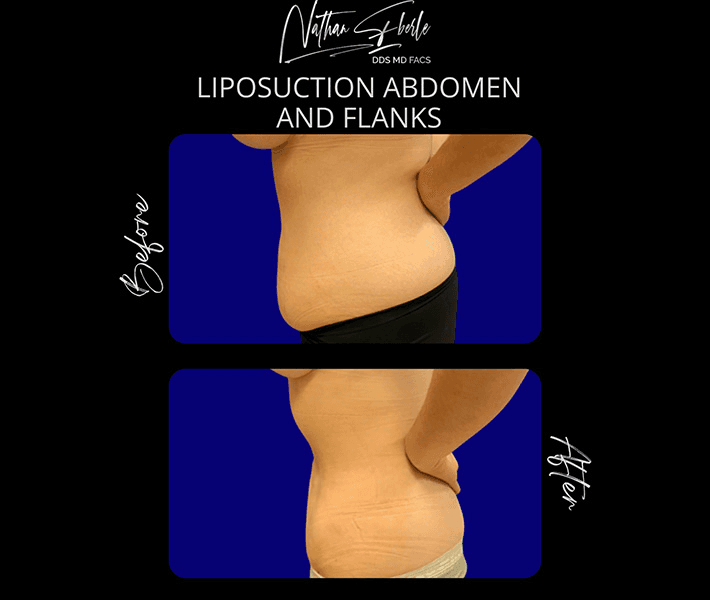 Liposuction before and after case 56, actual patient at Weston Center for Plastic Surgery