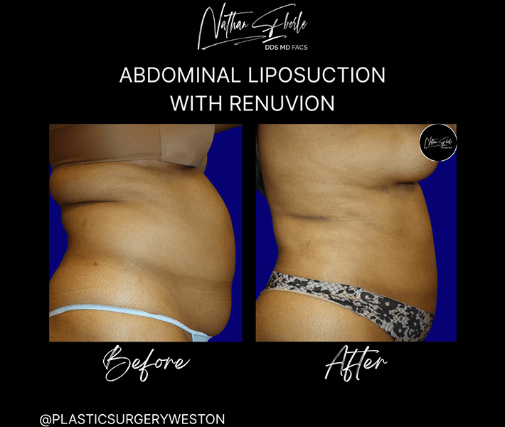 Liposuction before and after case 57, actual patient at Weston Center for Plastic Surgery