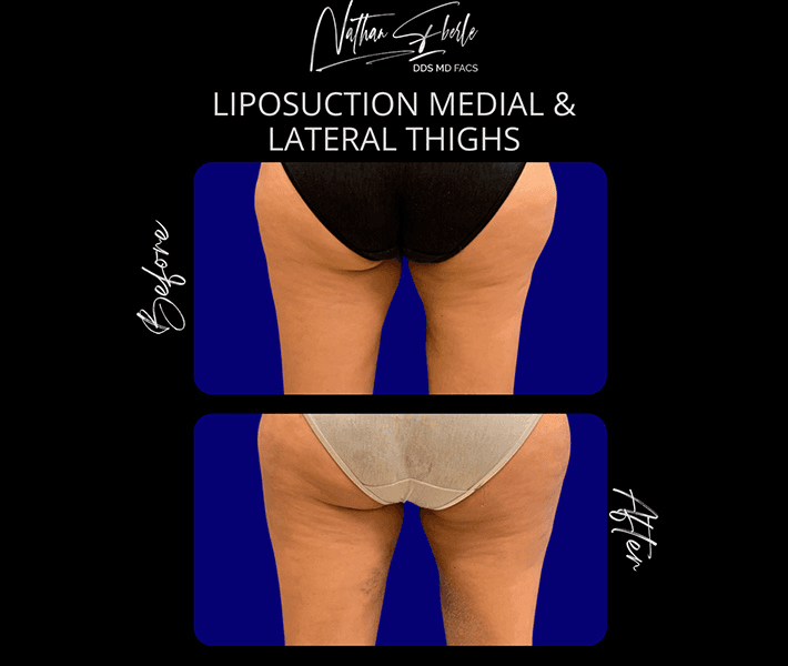 Liposuction before and after case 58, actual patient at Weston Center for Plastic Surgery