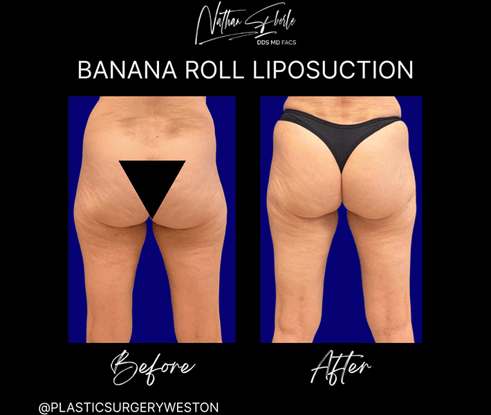 Liposuction before and after case 59, actual patient at Weston Center for Plastic Surgery