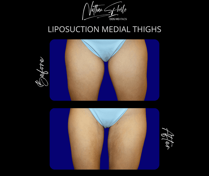 Liposuction before and after case 6, actual patient at Weston Center for Plastic Surgery