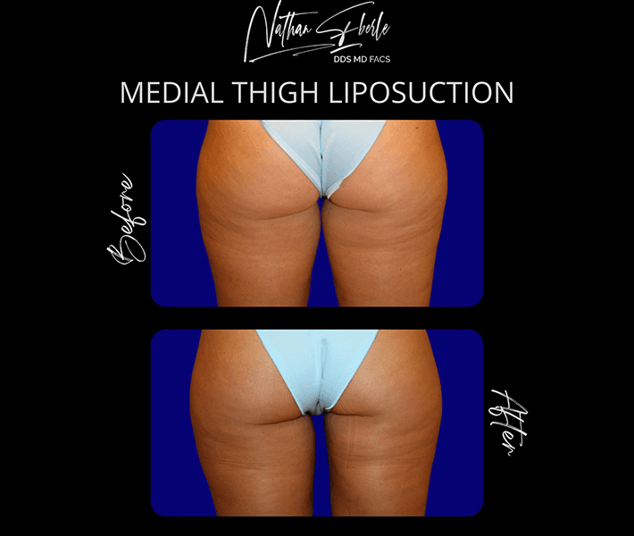 Liposuction before and after case 60, actual patient at Weston Center for Plastic Surgery