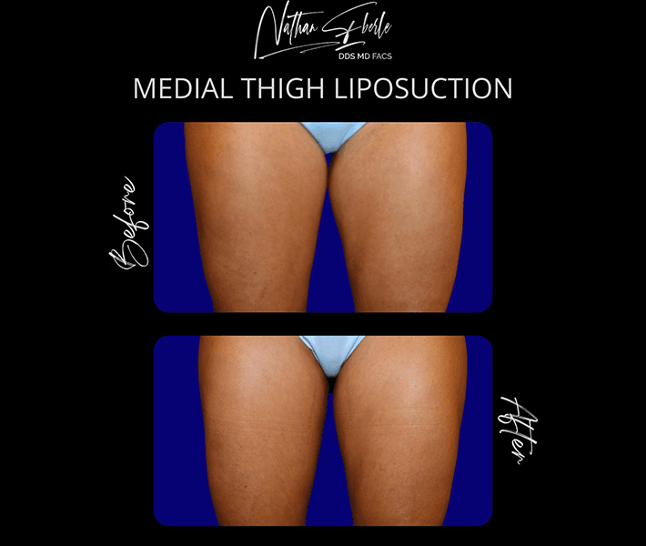 Liposuction before and after case 61, actual patient at Weston Center for Plastic Surgery