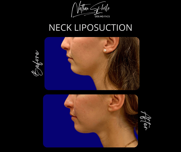 Liposuction before and after case 62, actual patient at Weston Center for Plastic Surgery