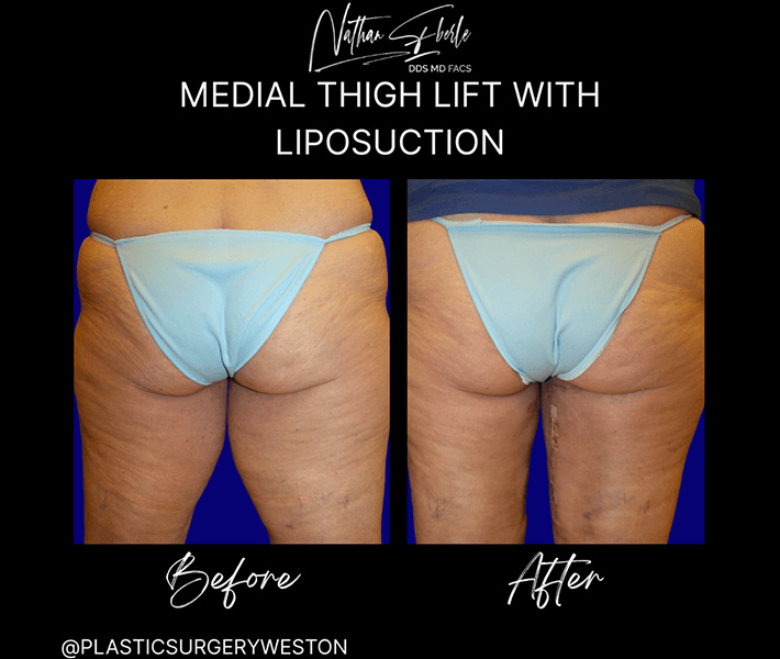 Liposuction before and after case 63, actual patient at Weston Center for Plastic Surgery