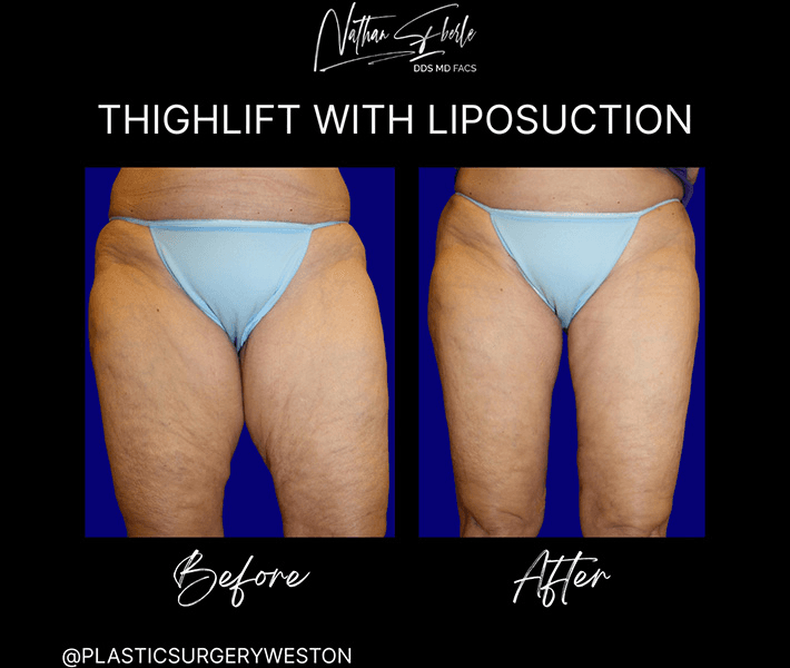 Liposuction before and after case 64, actual patient at Weston Center for Plastic Surgery